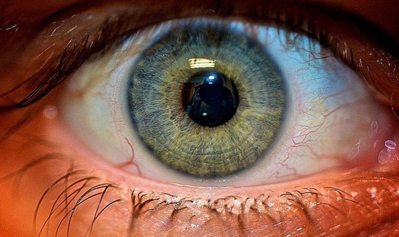 Атрофия сетчатки глаза