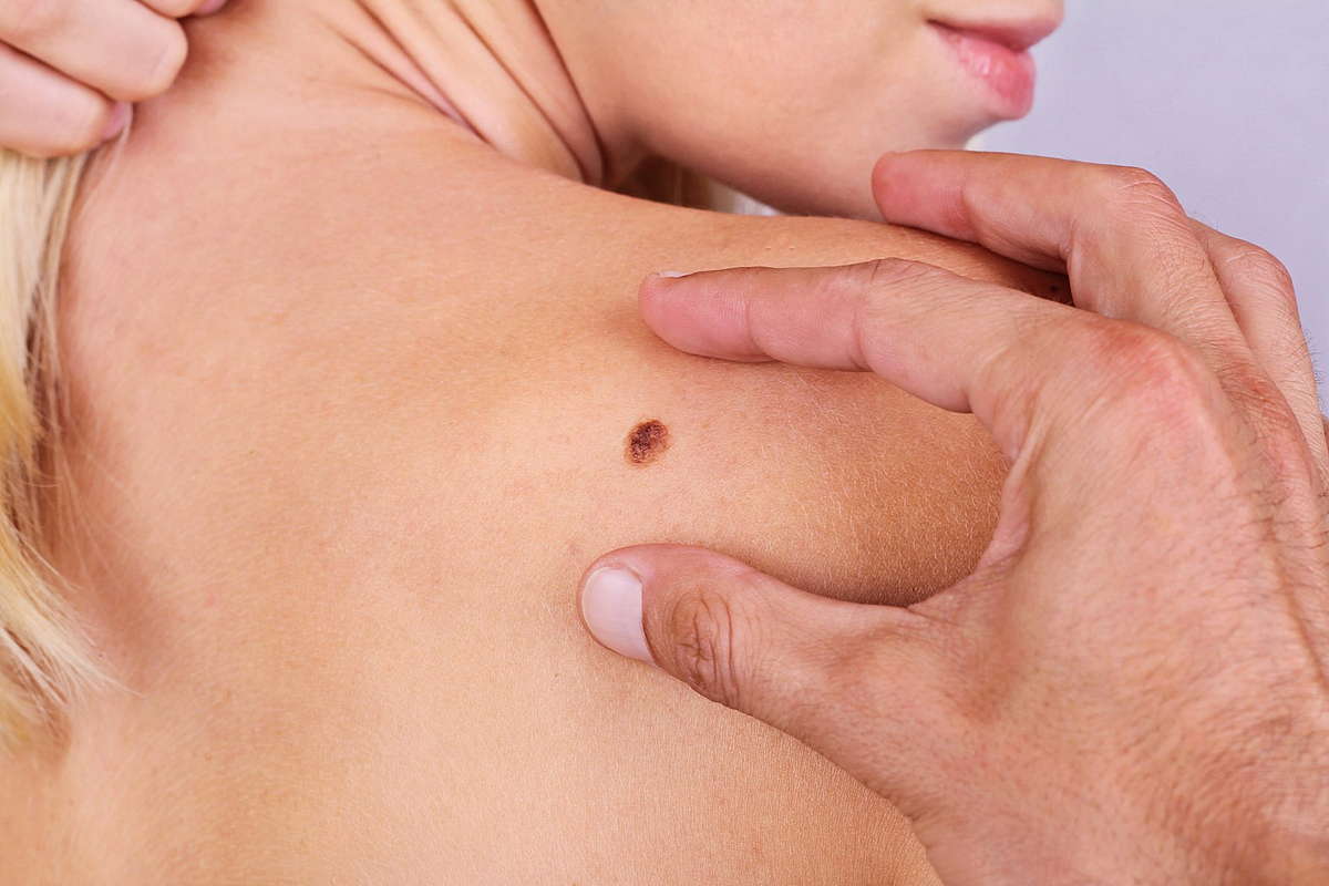 распространенные виды рака кожи родинка на теле