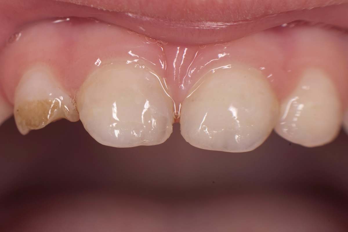кариес передних молочных зубов