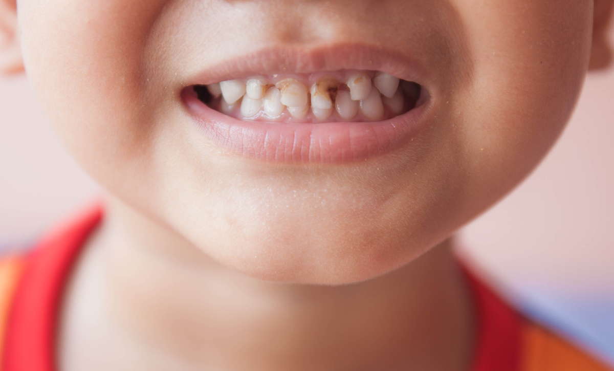 Зубы с кариесом у детей