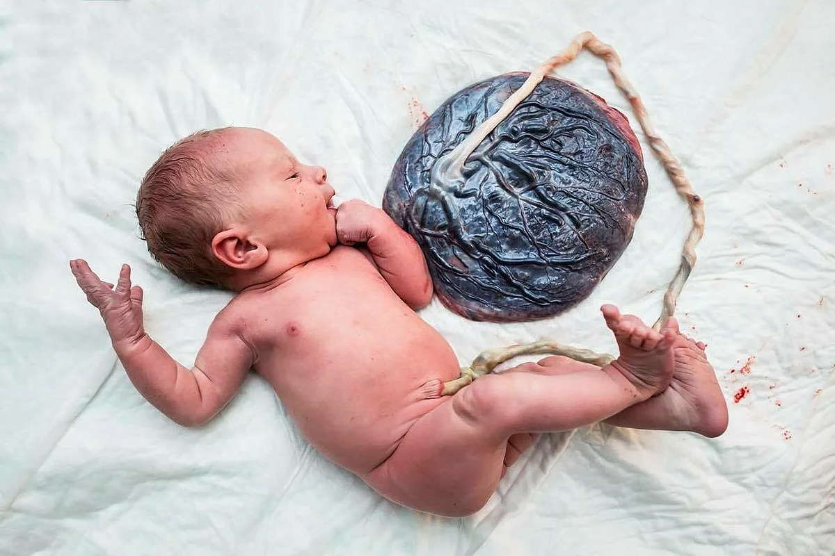 Плацента и пуповина новорожденного