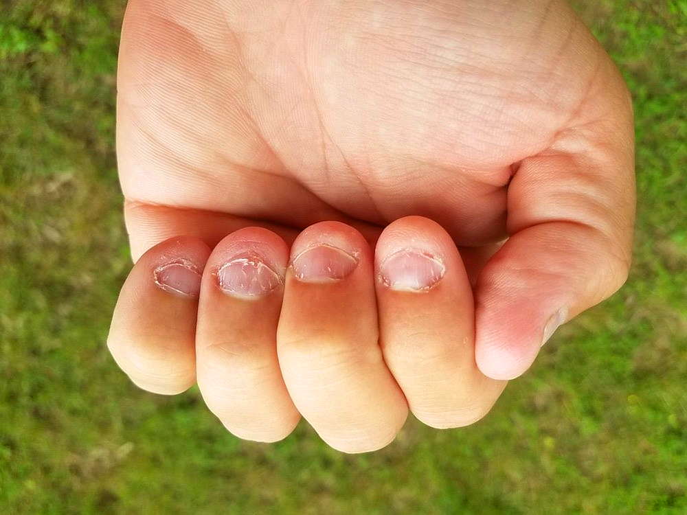 Обкусанные ногти на руках ребенка